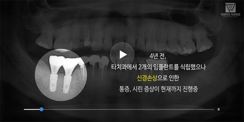 재수술 임플란트 치료 동영상 이미지, 클릭하시면 동영상이 재생됩니다.